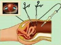 腹腔镜